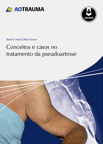 Livro - Conceitos e Casos no Tratamento da Pseudoartrose - Dr. Sizinio Kanan Hebert - Ortopedia e Neuro-Ortopedia Pediátrica